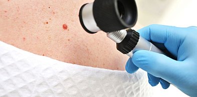 Zmiany barwnikowe skóry – które wymagają diagnostyki?