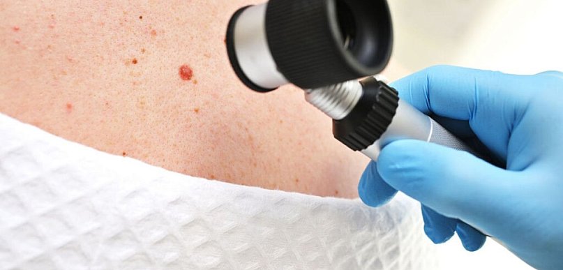 Zmiany barwnikowe skóry – które wymagają diagnostyki?