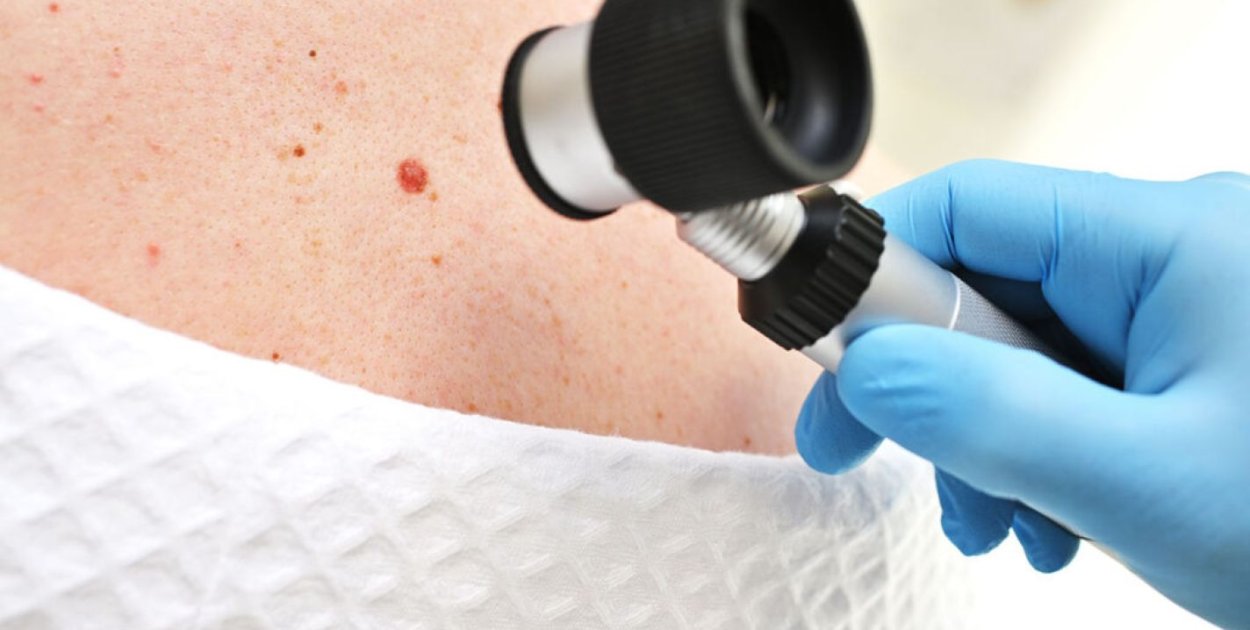 Zmiany barwnikowe skóry – które wymagają diagnostyki?